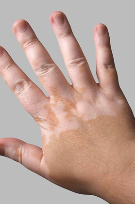 Vitiligo