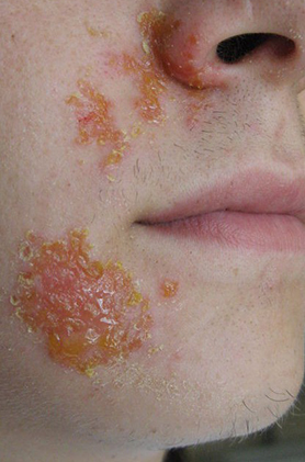 Impetigo