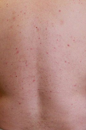 Folliculitis