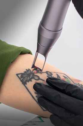 Laser tattoo removal, advanced skin treatment, tattoo removal procedure, Anudhi Clinic, Chennai