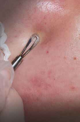 Comedone extraction, acne treatment, blackhead removal, Anudhi Clinic, Chennai