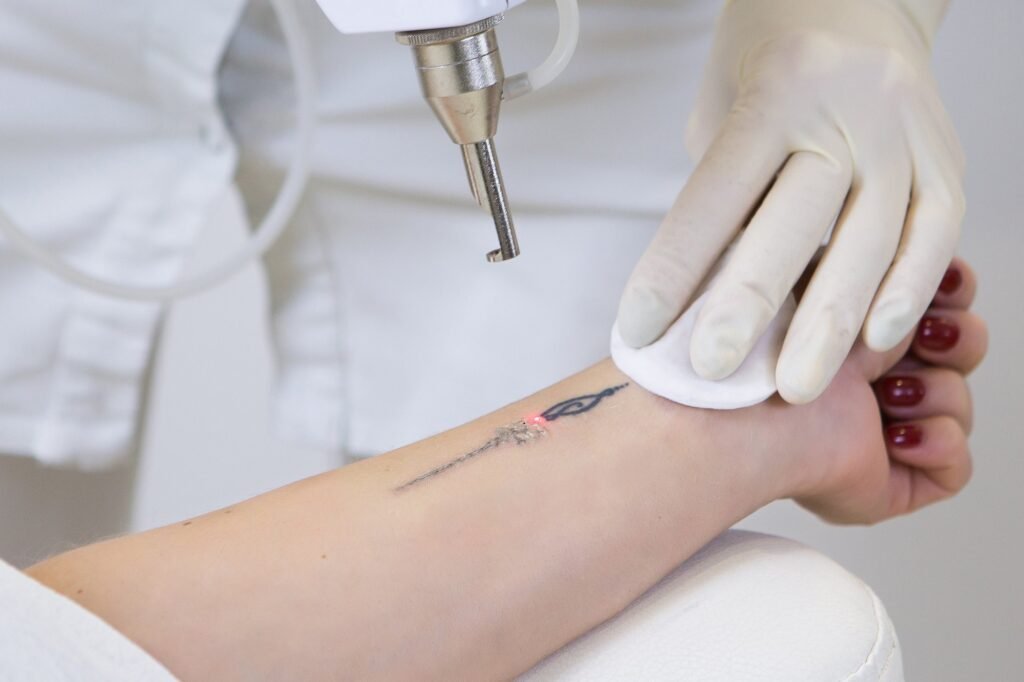 best LASER tattoo removal in Chennai