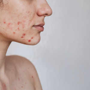 How to Remove Acne Scars Permanently