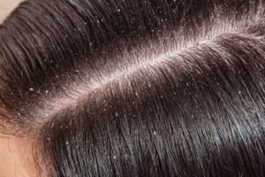 Dandruff Treatment in Chennai: Causes, Symptoms & Effective Solutions