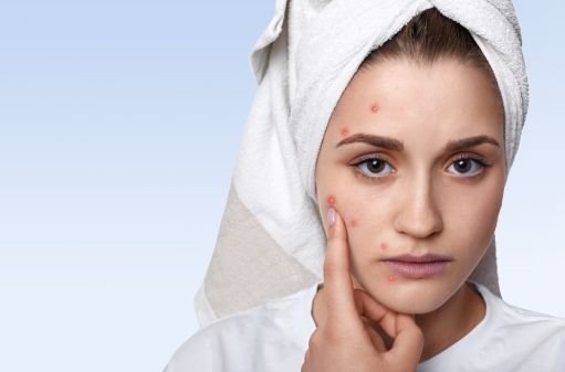 Different Types of Acne