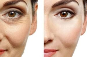 Botox Treatment in Chennai – Benefits, Cost, and What to Expect