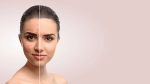 DPN Removal in Chennai – Causes, Treatment Options & What to Expect