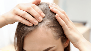 Female Hair Loss in Chennai – Causes, Patterns & Treatment Options