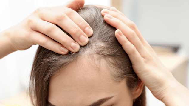 female pattern hair loss