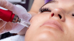 Microneedling Radio Frequency Treatment in Chennai – Benefits, Procedure, Results & Everything You Need to Know